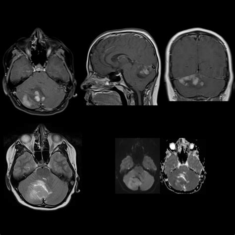 Medulloblastoma