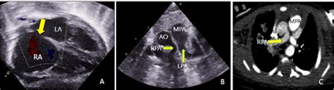 Figure 2 From Right Pulmonary Artery Originating From Ascending Aorta