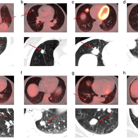 ¹⁸Fluorodeoxyglucosepositron emission tomography computed tomography