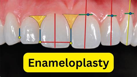 What is enameloplasty or odontoplasty? - YouTube