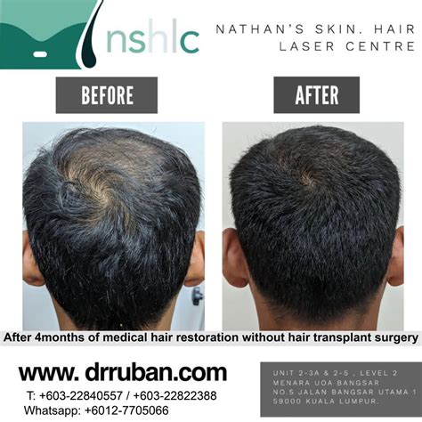 Hair Transplant Dermatologist Malaysia Hair Transplant Clinic