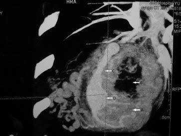 Primary Cardiac Paraganglioma With Intratumoral Coronary Artery