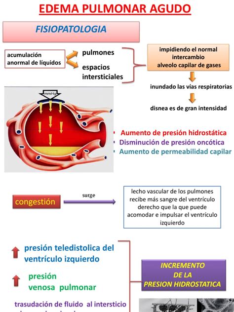 Fisiopatologia Edema Pulmonar Agudo Edema Pulmón