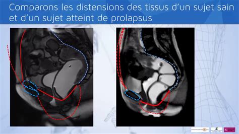 Mobilité Des Organes Pelviens Féminins Prolapsus Descente Dorgane