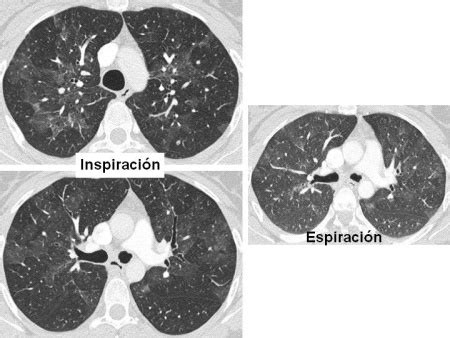 Patron En Mosaico Pneumowiki Enciclopedia De Neumolog A Y Neumociencias