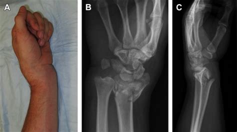 Wrist Distal Radius Fracture Gulfsheet