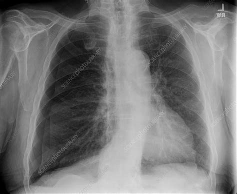 Tension Pneumothorax Xray