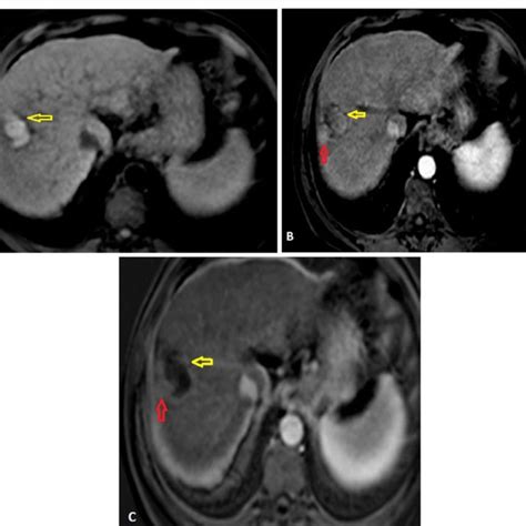 A 65 Year Old Male Patient With Liver Cirrhosis Underwent Download