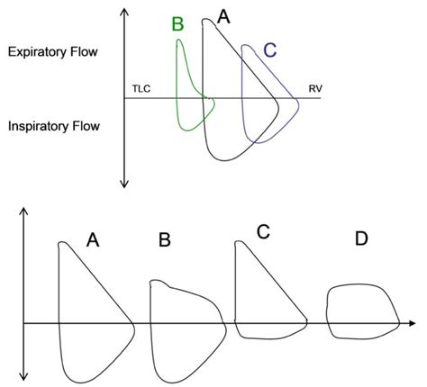 Pulmonary Function Testing Pulmonology Advisor