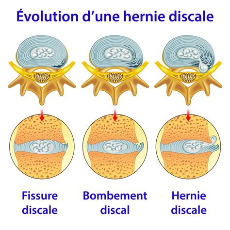 Hernie Discale Quoi Faire Pour Soulager La Douleur Et Viter Les