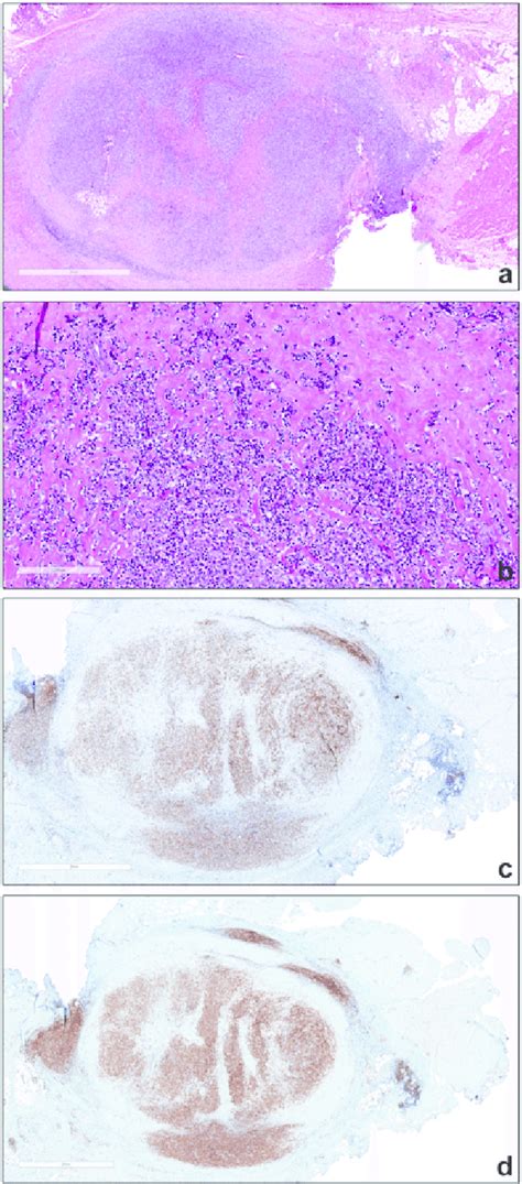 A HE Stained Section Shows Connective Tissue With Massive Hyalinization