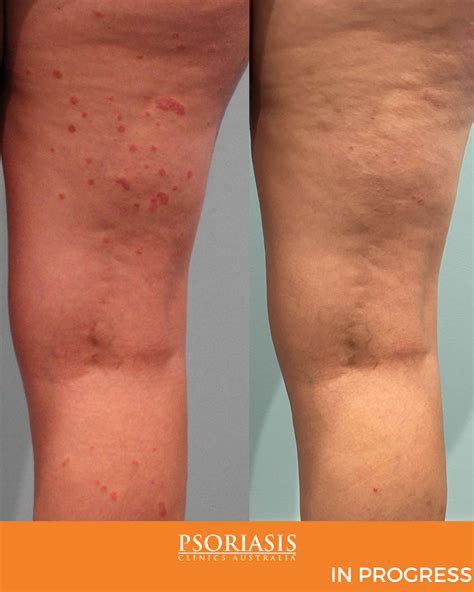 Psoriasis Specialist Gallery Psoriasis Clinics Australia