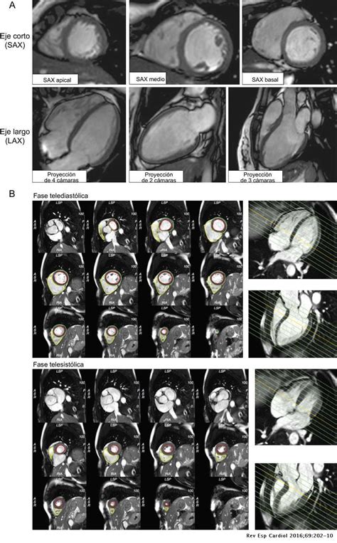 Resonancia Magnética Cardiovascular En La Práctica Cardiológica Una