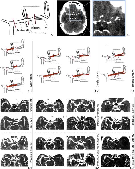 A Middle Cerebral Artery Mca Configuration Proximal M1 Distal M1