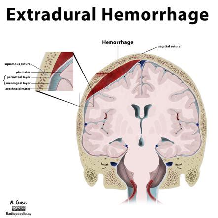 Extradural Haematoma Vs Subdural Haematoma Radiology Reference