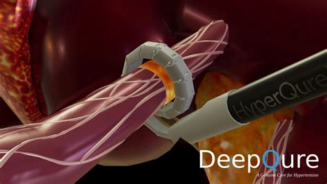 Deepqure Receives Ide Approval Of Extravascular Renal Denervation