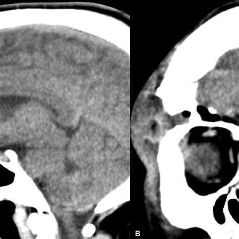 A -Right supraorbital craniotomy with one burr hole. B -Anterior ...