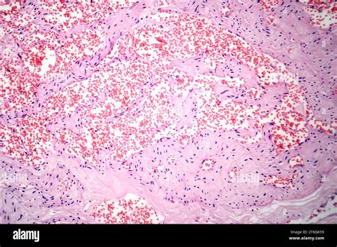 Photomicrograph Of Capillary Hemangioma Illustrating Abnormal