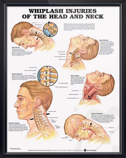 Whiplash Injuries Anatomy Poster Defines Whiplash Showing Hyperflexion