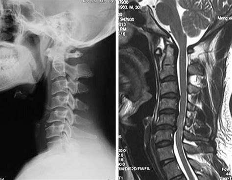 Cervical Kyphosis Mri