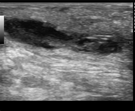 Pilonidal Sinus With Abscess Formation Image