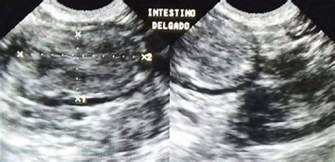 Abdominal Us Duodenal Mass Note Mass Mixed Echogenicity Which Is