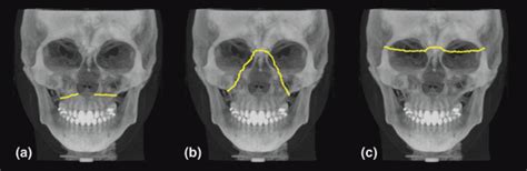 Le Fort Fracture X Ray