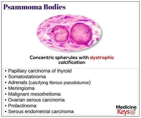 Psammoma Bodies Medicine Keys For Mrcps