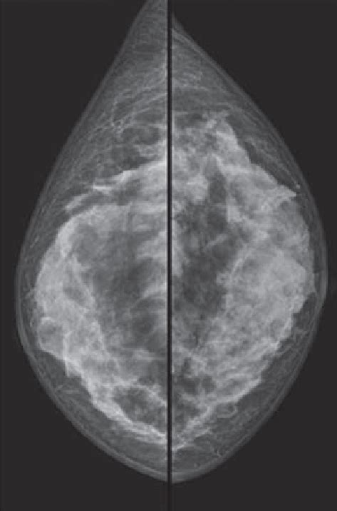 Mammography Right And Left Craniocaudal Views Demonstrating Bilateral