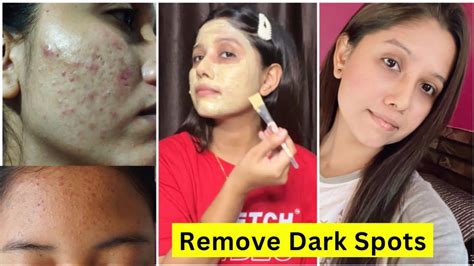 Remove Acne Scars Pimples Tiny Bumps Brown Spots Get Clear Glowing