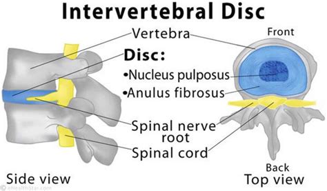 Discitis Discitis Osteomyelitis Causes Symptoms Diagnosis And Treatment