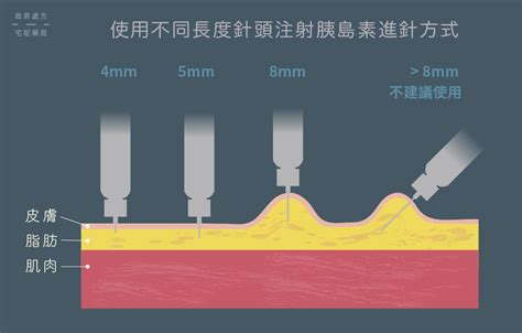 圖解胰島素注射步驟，輕鬆降血糖