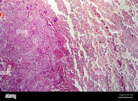 Lung Adenocarcinoma Light Micrograph Photo Under Microscope Stock