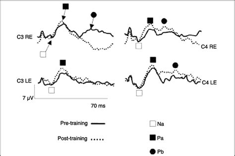 Comparison Of Middle Latency Response Before And After Auditory