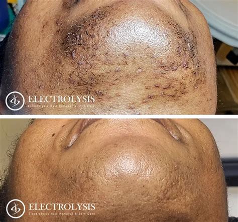 Electrolysis Before And After 100 Permanent Hair Removal