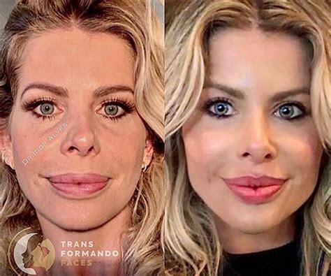 Cirurgi O Mostra Antes E Depois De Preenchimentos De Karina Bacchi