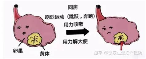 你了解黄体破裂吗？ 知乎