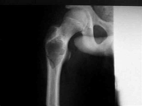 Simple Bone Cyst Unicameral Wheeless Textbook Of Orthopaedics