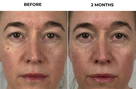 Surprising Nuface Results After Day Before After Photos 60 Off