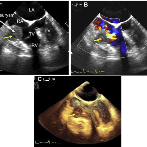 Two Dimensional TTE Modified Right Ventricular Inflow View Shows A