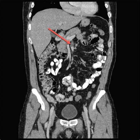 Superior Mesenteric Artery Ct Anatomy