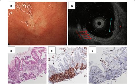 A Esophagogastroduodenoscopy Showing A Submucosal Lesion In The Download Scientific Diagram