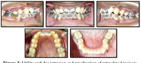 Figure 1 From Class Ii Correction With Forsus Fixed Functional Appliance In Class Ii Division 2