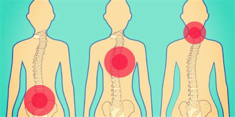 About Different Types of Back Pain | Dr. Lalit Bhardwaj