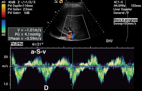 Doppler Us Of The Liver Made Simple Radiographics