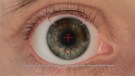 Preguntas Y Respuestas Sobre La Cirugía Refractiva Láser Lasik