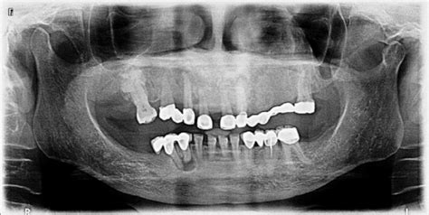 Enfermedad De Paget Comprometiendo El Maxilar Superior Dento Metric