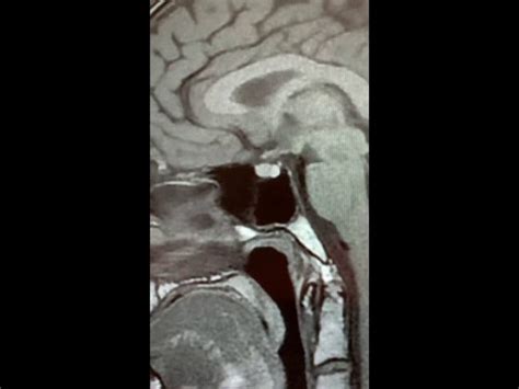 Pituitary Mri Educational Series Normal Posterior Pituitary Gland