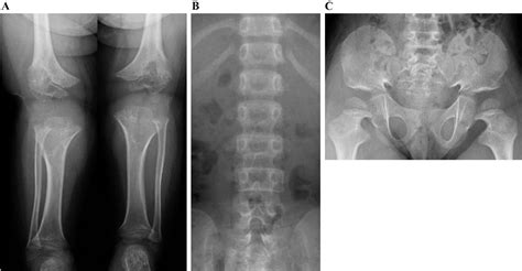 Figure 1 From Clinical Practice Guidelines For Achondroplasia