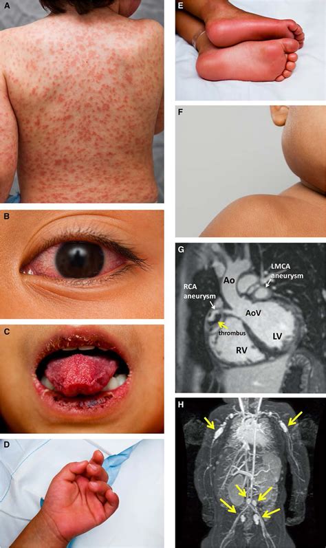 Diagnosis Treatment And Long Term Management Of Kawasaki Disease A